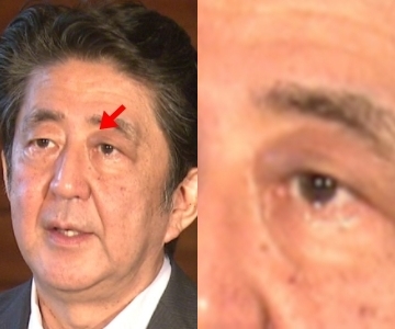 画像 安倍晋三首相の左目まぶたの腫れ アザはいつから 原因は何